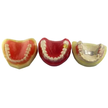 Bir set içerir 3 modelleri diş protez modeli